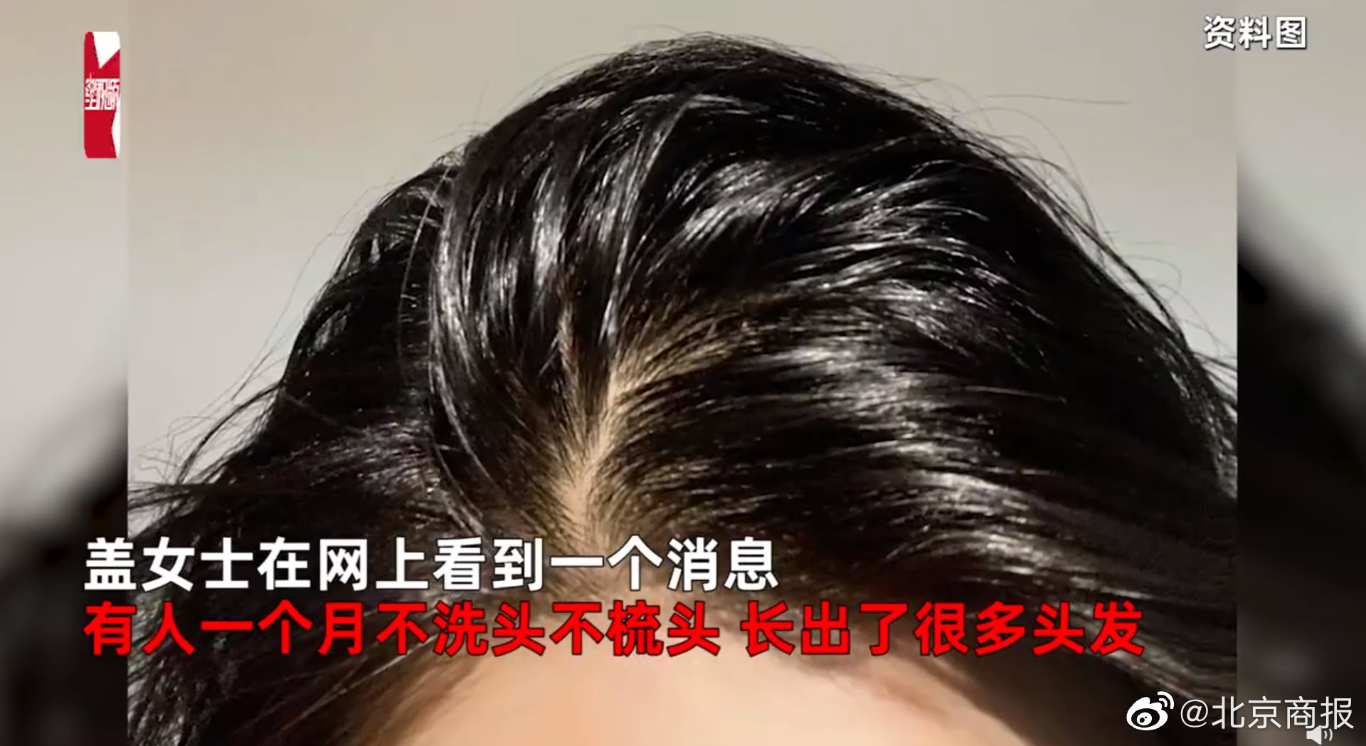 女子怕头秃3个月不洗头，惊喜长出碎发结果悲剧了！你为了防秃都干过啥休闲区蓝鸢梦想 - Www.slyday.coM