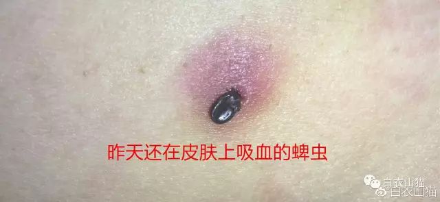青岛20多人因蜱虫叮咬住院，4人不幸死亡。蜱虫为何会使人生病？被叮咬后该如何处理才安全？请及时用正确方法取出蜱虫！休闲区蓝鸢梦想 - Www.slyday.coM