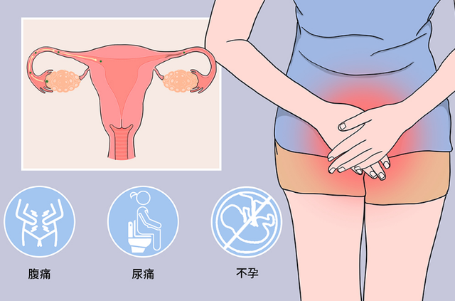双侧输卵管梗阻积水中西医结合调理助她4个月接好孕