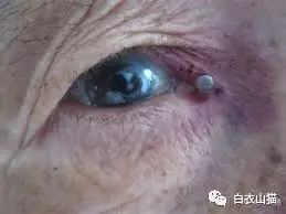 青岛20多人因蜱虫叮咬住院，4人不幸死亡。蜱虫为何会使人生病？被叮咬后该如何处理才安全？请及时用正确方法取出蜱虫！休闲区蓝鸢梦想 - Www.slyday.coM