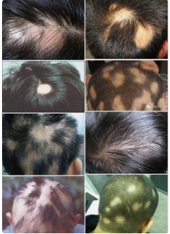 孩子出现鬼剃头头发出现斑块到底是为什么