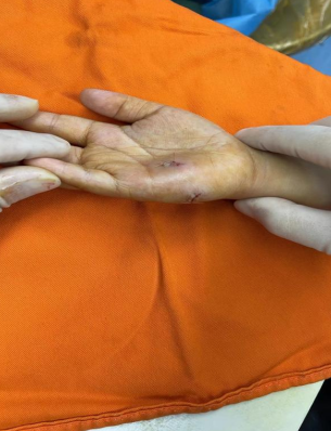 如竹签,钉,针等)锐器伤(如刀,玻璃,金属锐利边缘等)钝器伤(如健身器材