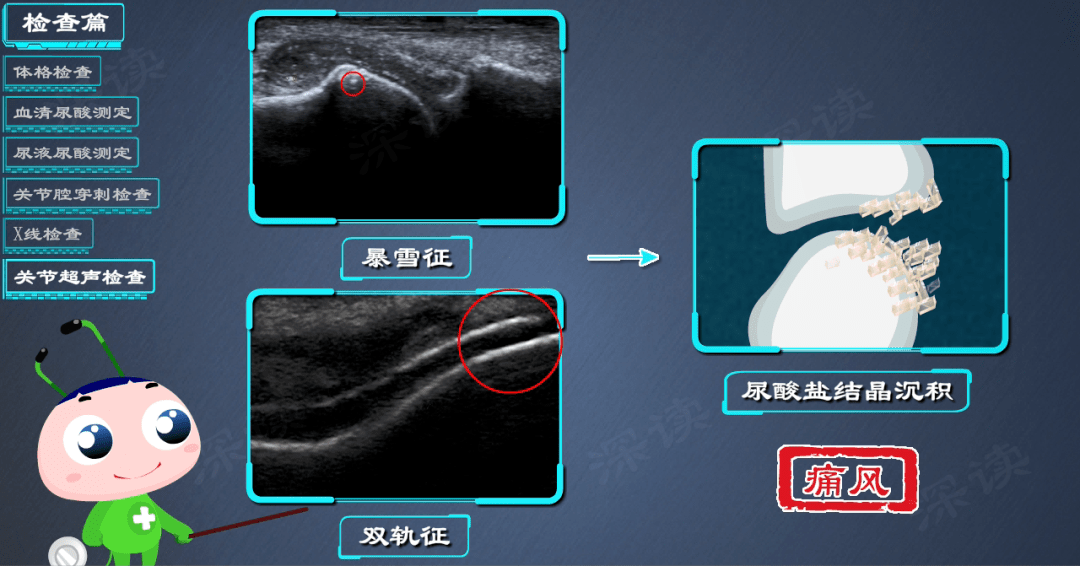 在超声下观察关节软骨表面,如出现双层平行强回声,称为"双轨征"在超声