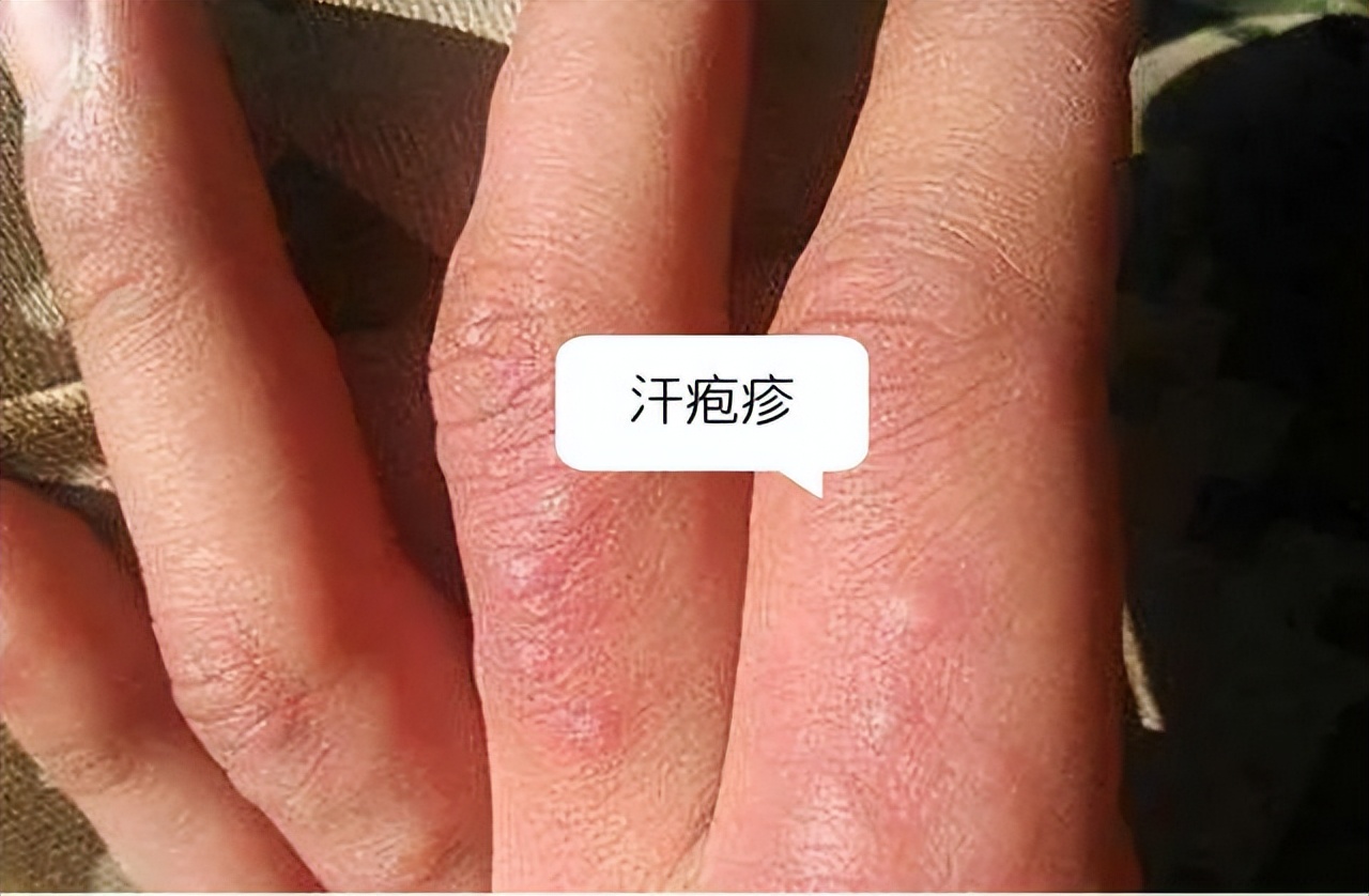 手上长水疱,瘙痒易复发,汗疱疹又来了