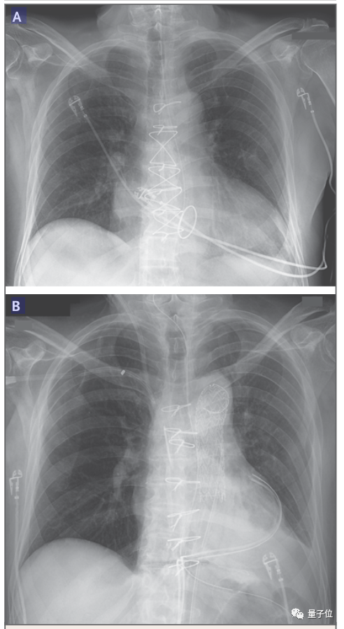 首例猪心移植细节全面披露：患者体内发现人类疱疹病毒，死后心脏重量翻倍，心肌细胞纤维化丨团队最新论文休闲区蓝鸢梦想 - Www.slyday.coM