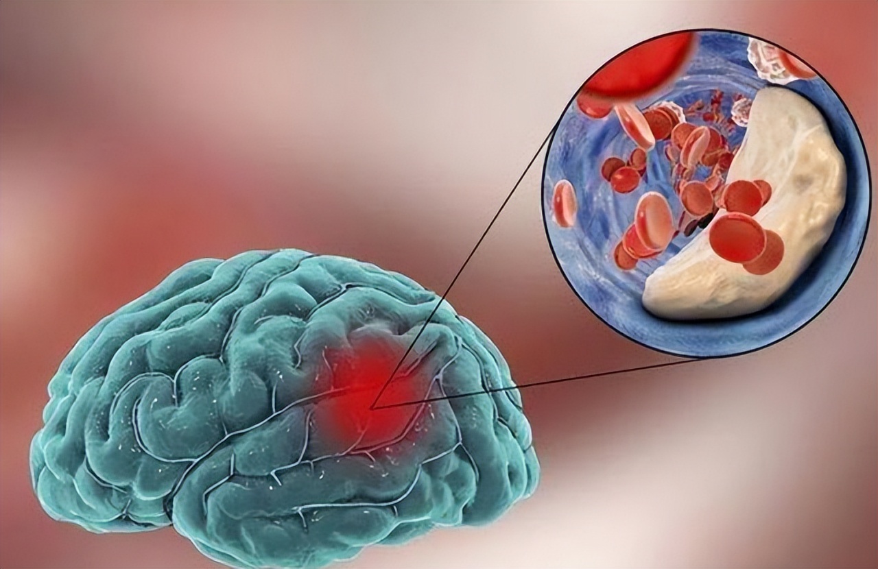 脑供血不足的人,或许会出现5个表现,想要改善,建议多吃5种食物休闲区蓝鸢梦想 - Www.slyday.coM 脑供血不足的人,或许会出现5个表现,想要改善,建议多吃5种食物休闲区蓝鸢梦想 - Www.slyday.coM