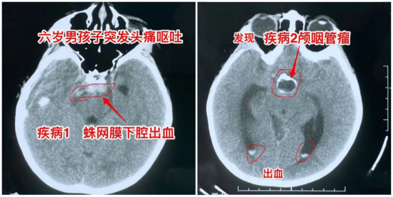 6岁男孩脑子里同时藏了“脆皮炸弹”和“最可怕的肿瘤”休闲区蓝鸢梦想 - Www.slyday.coM 6岁男孩脑子里同时藏了“脆皮炸弹”和“最可怕的肿瘤”休闲区蓝鸢梦想 - Www.slyday.coM