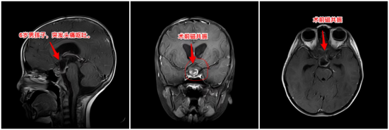 6岁男孩脑子里同时藏了“脆皮炸弹”和“最可怕的肿瘤”休闲区蓝鸢梦想 - Www.slyday.coM 6岁男孩脑子里同时藏了“脆皮炸弹”和“最可怕的肿瘤”休闲区蓝鸢梦想 - Www.slyday.coM