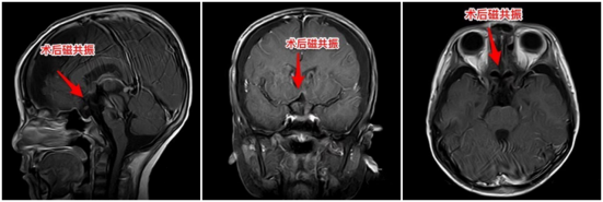6岁男孩脑子里同时藏了“脆皮炸弹”和“最可怕的肿瘤”休闲区蓝鸢梦想 - Www.slyday.coM 6岁男孩脑子里同时藏了“脆皮炸弹”和“最可怕的肿瘤”休闲区蓝鸢梦想 - Www.slyday.coM
