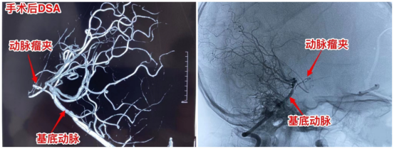 6岁男孩脑子里同时藏了“脆皮炸弹”和“最可怕的肿瘤”休闲区蓝鸢梦想 - Www.slyday.coM 6岁男孩脑子里同时藏了“脆皮炸弹”和“最可怕的肿瘤”休闲区蓝鸢梦想 - Www.slyday.coM