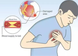 嗓子疼、牙疼、胃疼、咳嗽，这些还可能是心梗信号？咋判断？休闲区蓝鸢梦想 - Www.slyday.coM