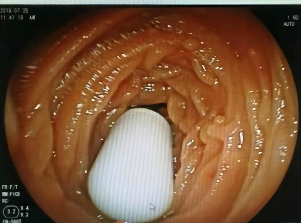 胶囊滞留体内一年小肠镜无创取出