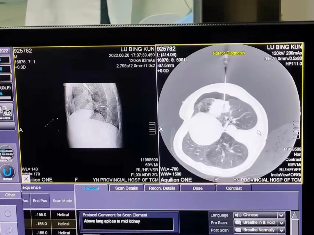 肺部CT能检查哪些疾病 胸部CT和肺部CT的区别是什么