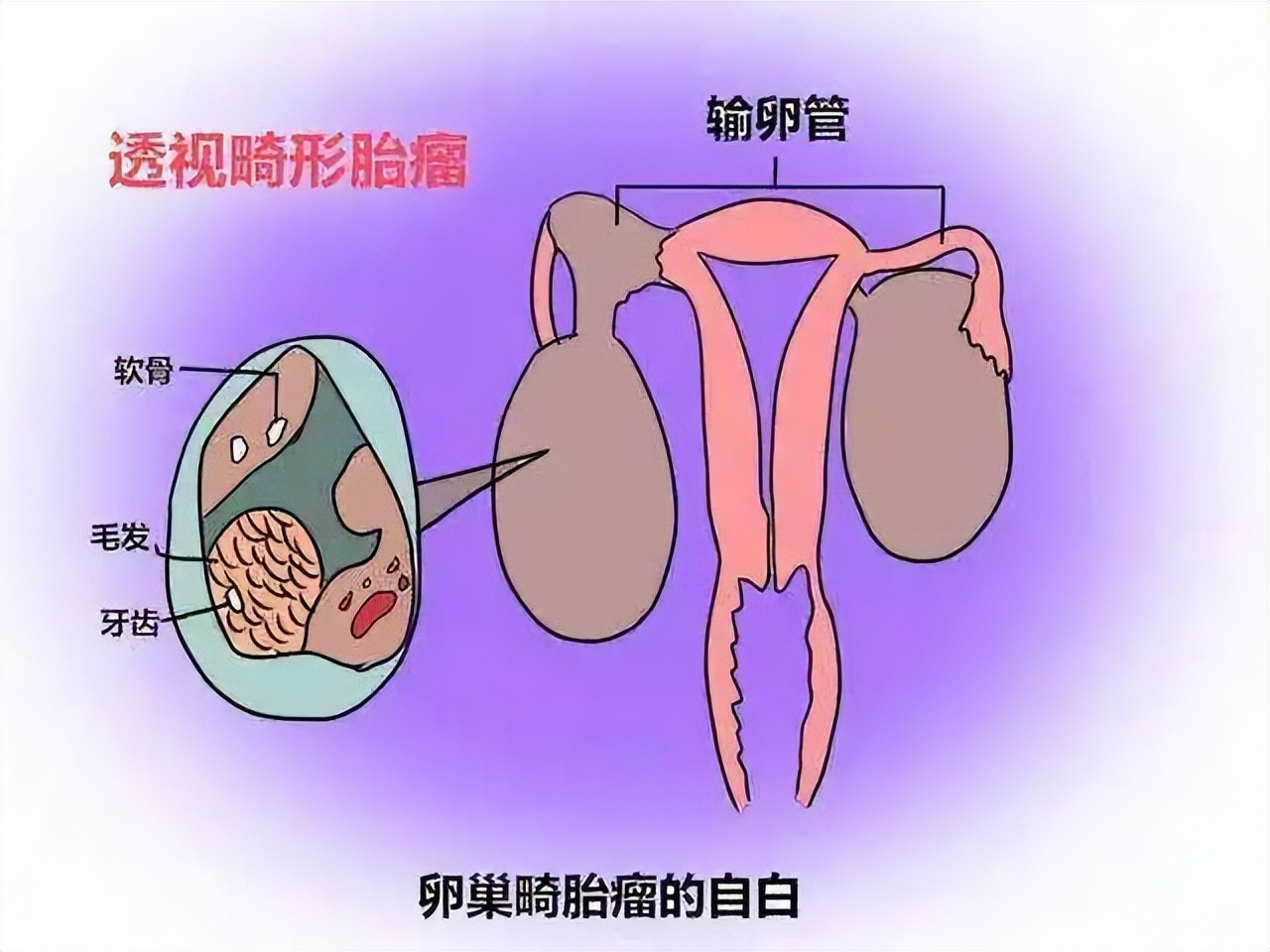花季少女长时间便秘,竟是卵巢畸胎瘤“作祟”休闲区蓝鸢梦想 - Www.slyday.coM 花季少女长时间便秘,竟是卵巢畸胎瘤“作祟”休闲区蓝鸢梦想 - Www.slyday.coM