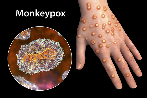 新冠未平，猴痘又起？来听感染专家王新宇讲述猴痘的前世今生休闲区蓝鸢梦想 - Www.slyday.coM