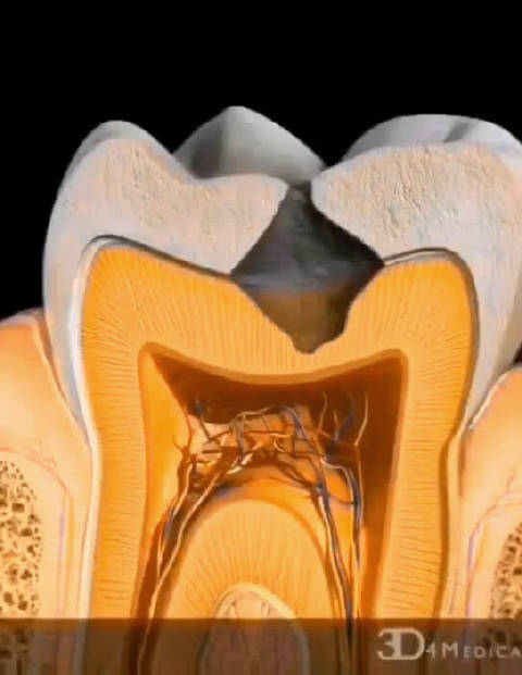 蛀牙是怎么一点点烂到牙髓,伤害牙神经导致牙髓炎根尖炎症的?