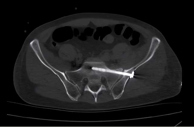 二一五医院骨科医院成功完成院内首例骨盆infix固定术