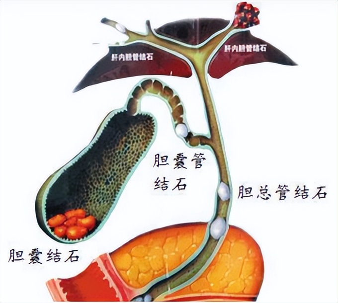 然而,手术取石可能导致胆漏,腹腔感染,切口感染等情况发生,有没有不