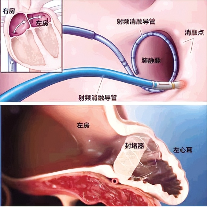 八旬阿婆反复心悸胸闷一站式手术除房颤防卒中