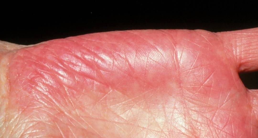 松开后又变回红色,而掌心颜色正常,可看见大量扩展连片的点片状小动脉