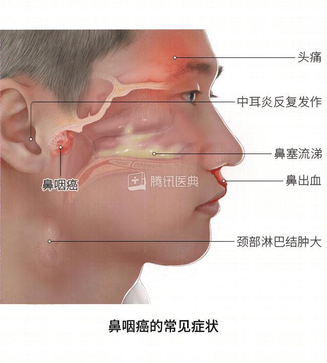 鼻咽癌早期图片图片