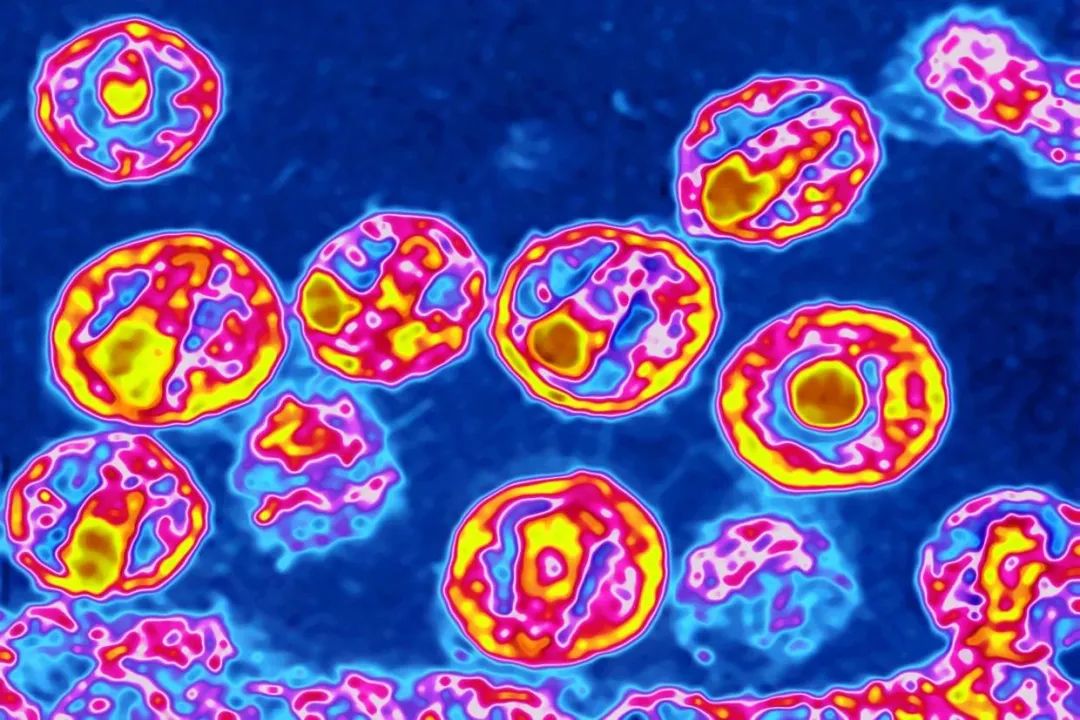 HIV病毒的彩色电子显微镜图像。来源：美国广播公司网站