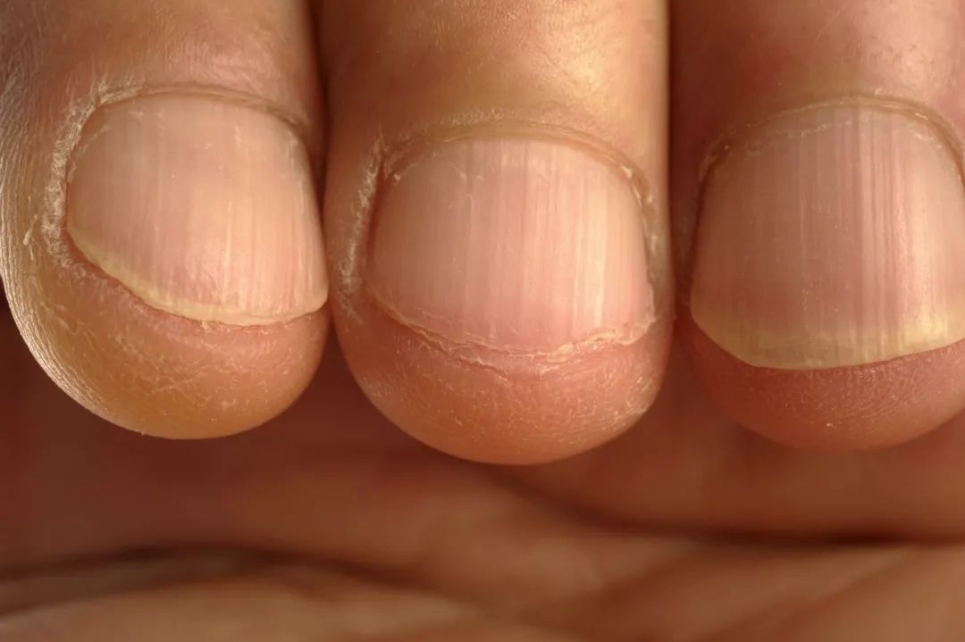 尿毒症手指甲竖纹图片图片