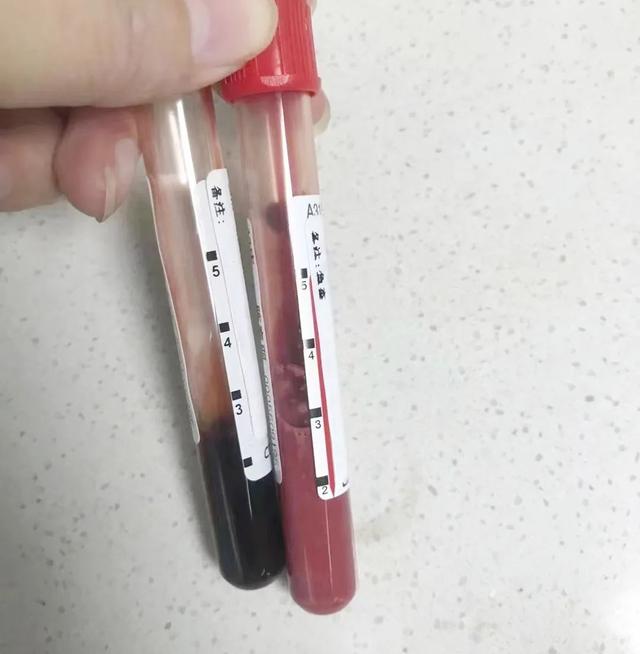 甘女士的血液(右)颜色明显比正常血液浅.院方供图