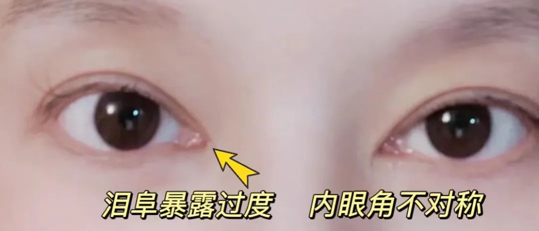 眼角开大导致泪阜暴露过多,迎风落泪,分泌物增多,眼干眼涩;去皮过狠