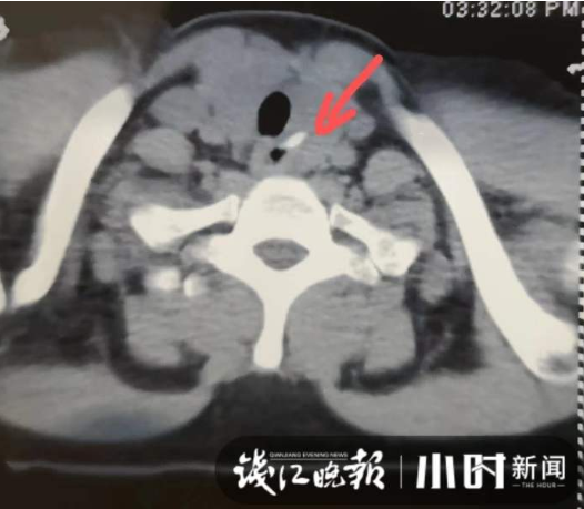 吃饭时真的不要笑！一女子连跑4家医院才搞定：吃尽苦头啊休闲区蓝鸢梦想 - Www.slyday.coM