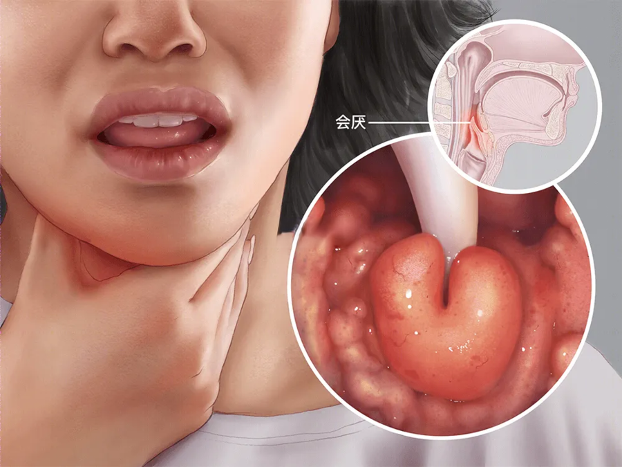 会厌炎恐怖之处就在于,患者自我感觉上完全无法辨识"嗓子疼"有什么