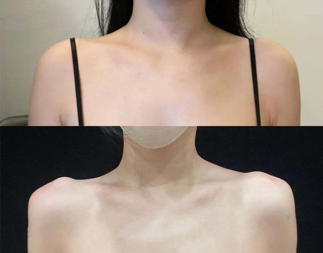 也有人喜欢肩峰突出的感觉,具体注射效果可以自己定制.