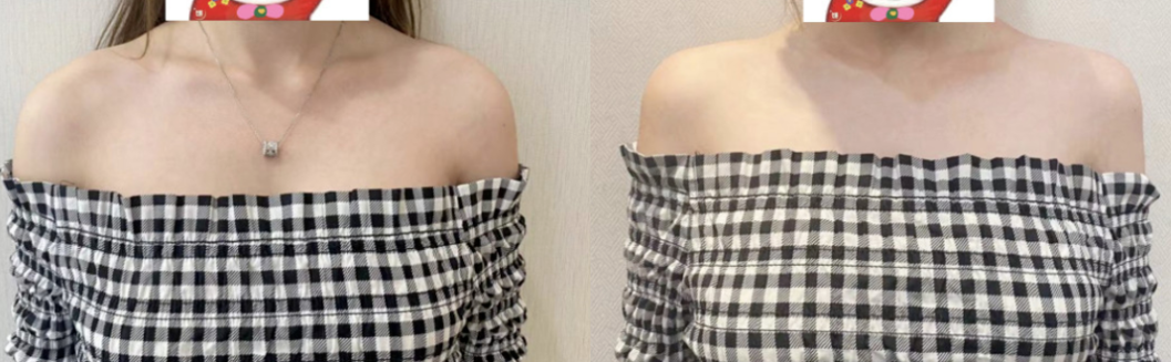 斜方肌|直角|肩膀_新浪新闻