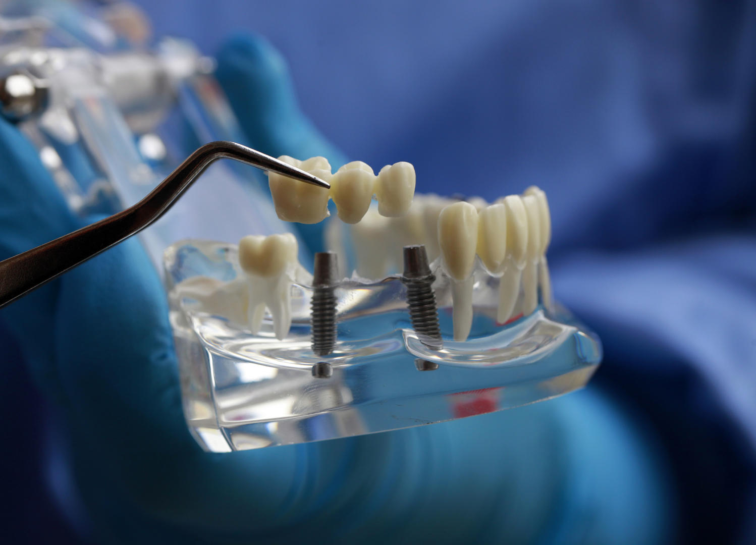 国家医保局发文引导种植牙牙冠形成合理价格,组建种植牙耗材省际采购