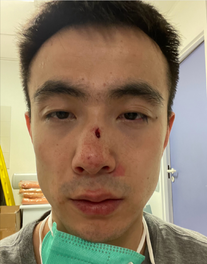 鼻子出大坑 完全扭曲,大概率留疤,或影响颜值!