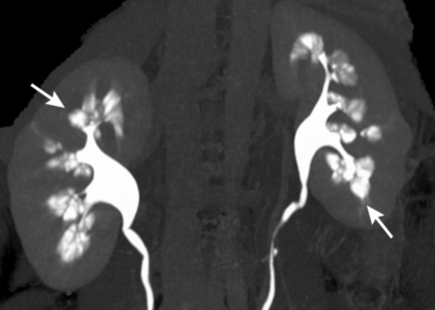 什么是海绵肾，严重吗？会遗传给我的孩子吗？结石疾病_新浪新闻