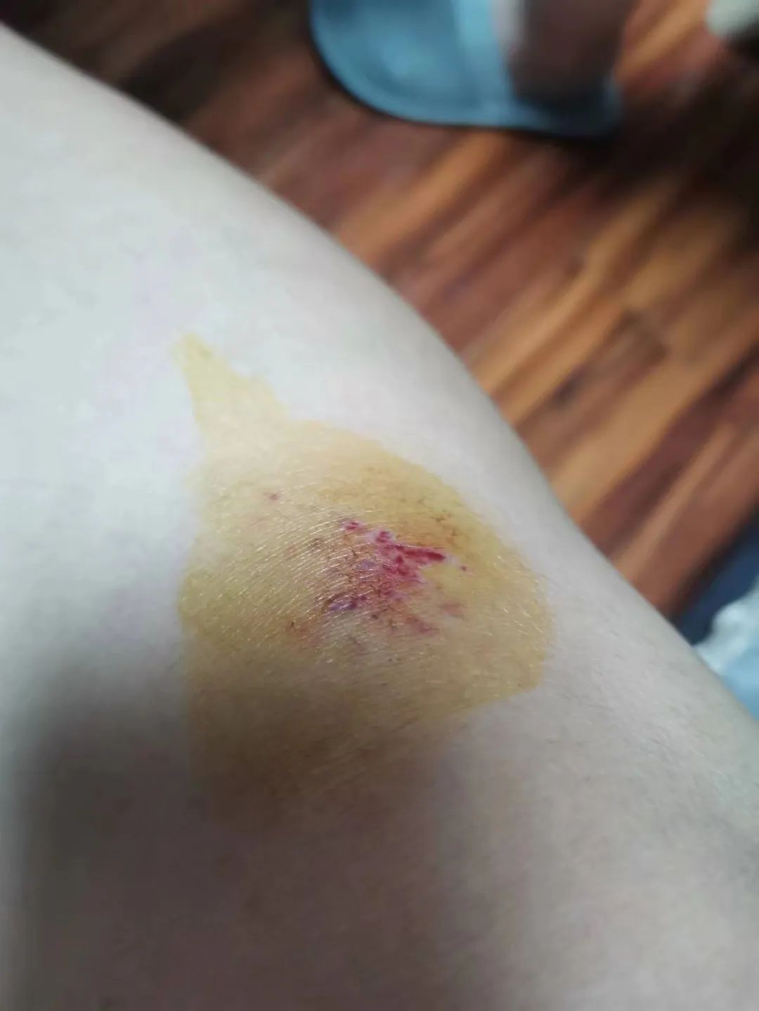 事发后,小杨坐在地上缓了片刻,才发现腿上被撞出一块淤青,而她的电动