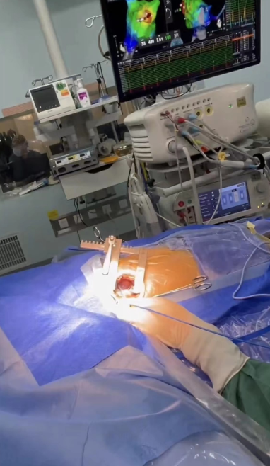 创伤小治疗造福患儿,首例直视下儿童房速心外膜射频消融术成功|手术