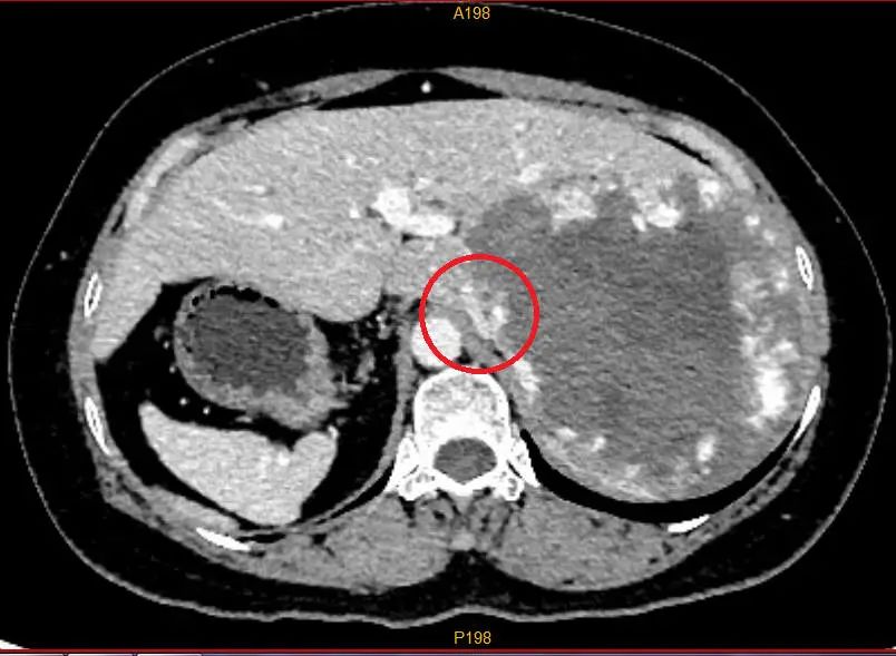 罕见！广西女子五脏六腑全部反着长，体内还有一块巨大的……休闲区蓝鸢梦想 - Www.slyday.coM