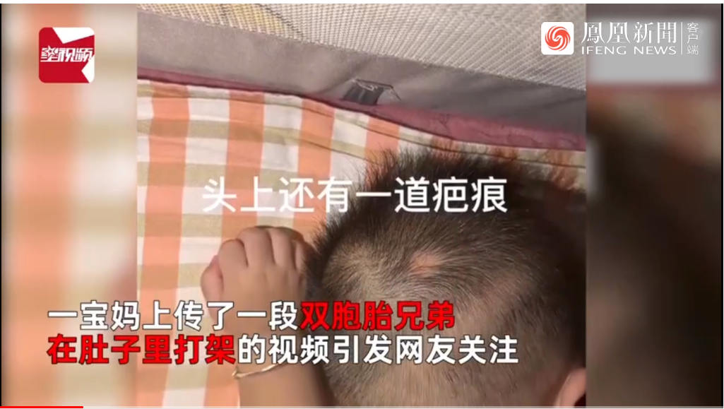 双胞胎在肚里打架出生后浑身淤青！平日相处也是“相爱相杀”休闲区蓝鸢梦想 - Www.slyday.coM