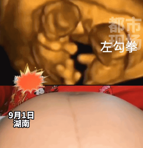 双胞胎出生后浑身淤青？原来是因为在肚子里“拳打脚踢”休闲区蓝鸢梦想 - Www.slyday.coM