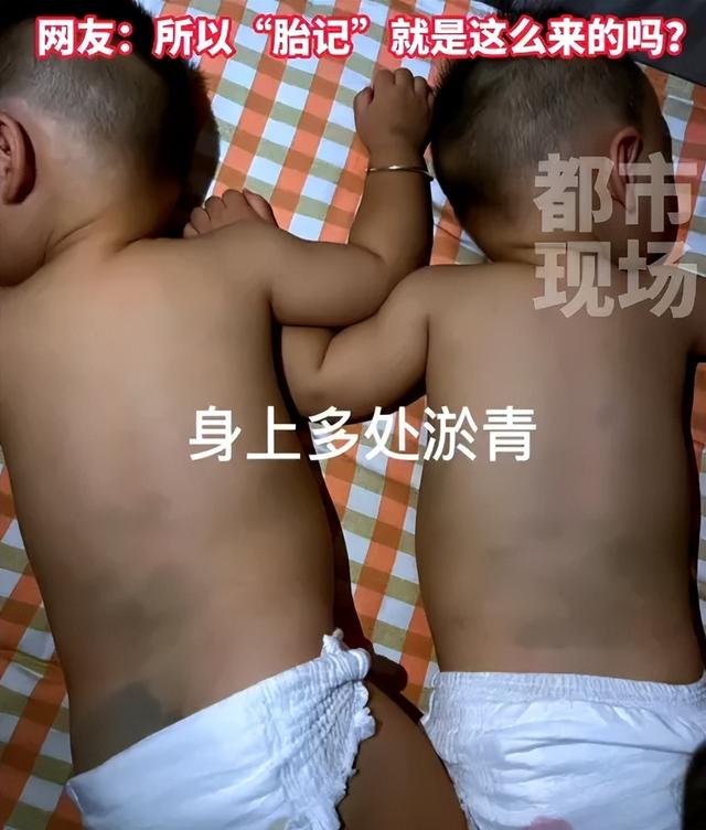 双胞胎出生后浑身淤青？原来是因为在肚子里“拳打脚踢”休闲区蓝鸢梦想 - Www.slyday.coM