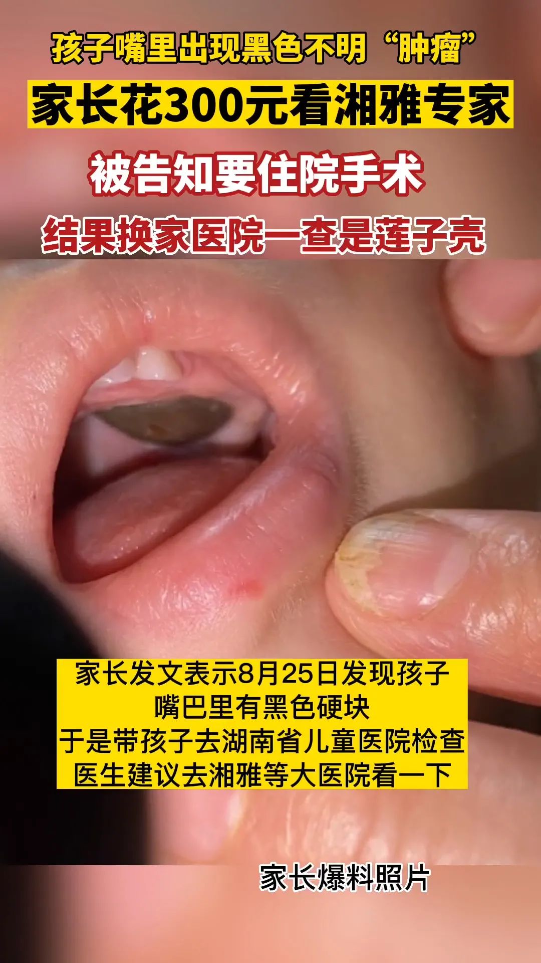 孩子嘴里出现肿块:湘雅医院诊断肿瘤,省医院棉签一拨去掉莲子壳休闲区蓝鸢梦想 - Www.slyday.coM 孩子嘴里出现肿块:湘雅医院诊断肿瘤,省医院棉签一拨去掉莲子壳休闲区蓝鸢梦想 - Www.slyday.coM