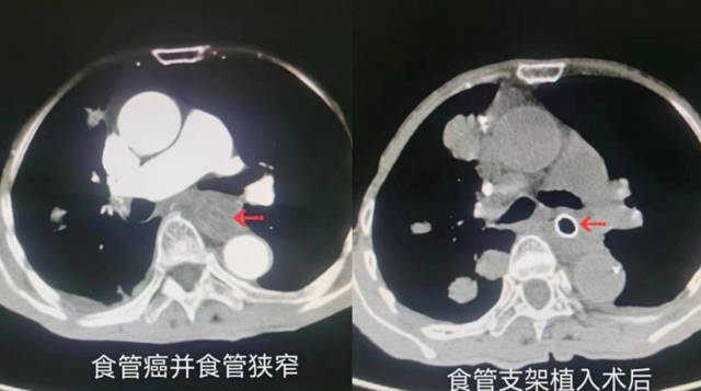 老人被肿瘤“扼住”食道，进食困难！气道支架“撑”开生命通道|食管|食管癌|肿瘤_新浪新闻