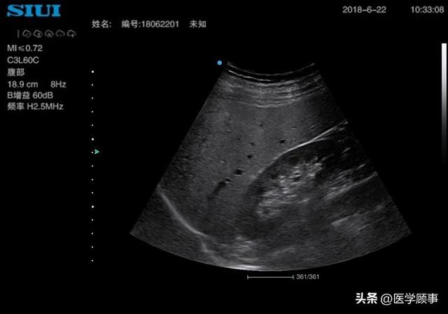 野战环境中的创伤超声重点评估(FAST)|CT_新浪新闻