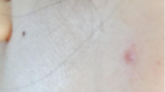 人各有“痣”,长在这些部位的痣易癌变!ABCDE法自测危险程度__财经头条