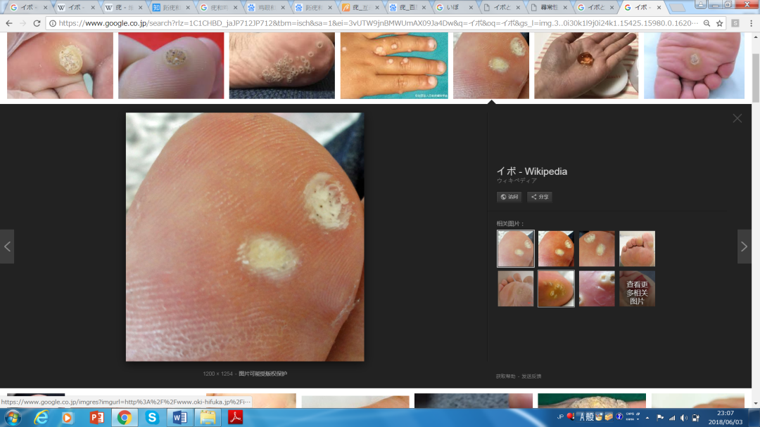 疣&nbsp;图片来源:wikimedia commons