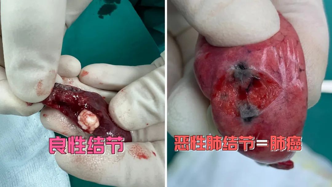 《我是大医生》带您识别危险结节|癌症|体检|乳腺_新浪新闻