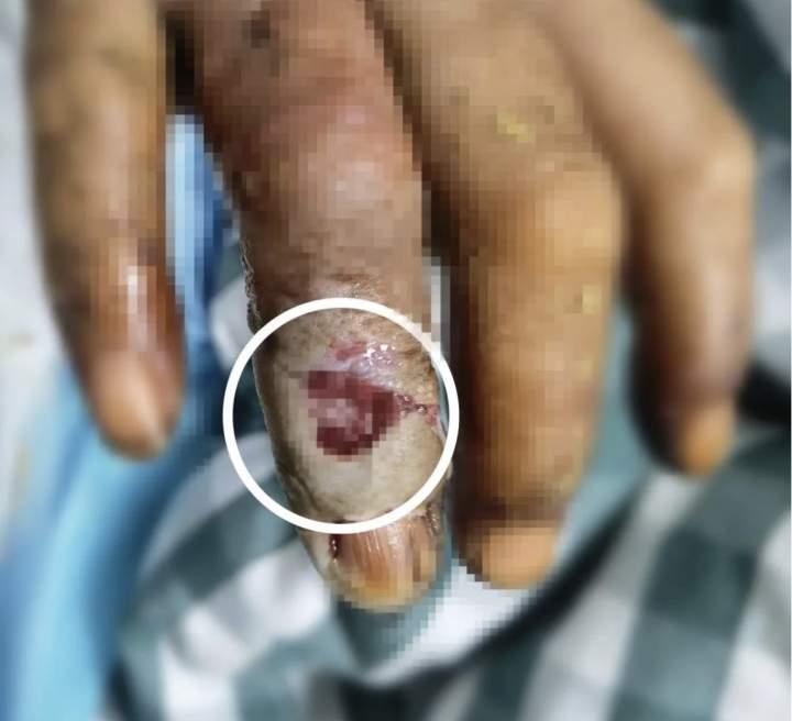 打板栗不慎被毒蛇咬伤，用了“土”方法，杭州男子差点丢命休闲区蓝鸢梦想 - Www.slyday.coM