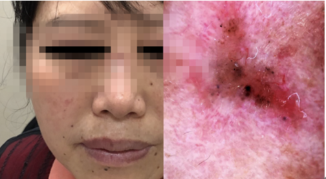 浙江女子陪闺蜜就诊，却被查出自己脸上有癌症，医生：幸好来得早......休闲区蓝鸢梦想 - Www.slyday.coM